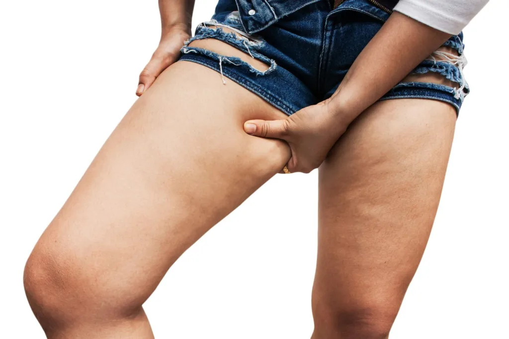 How to Reduce Thigh Fat: Effective Strategies for Toning and Shaping Your Legs 2 How to Reduce Thigh Fat